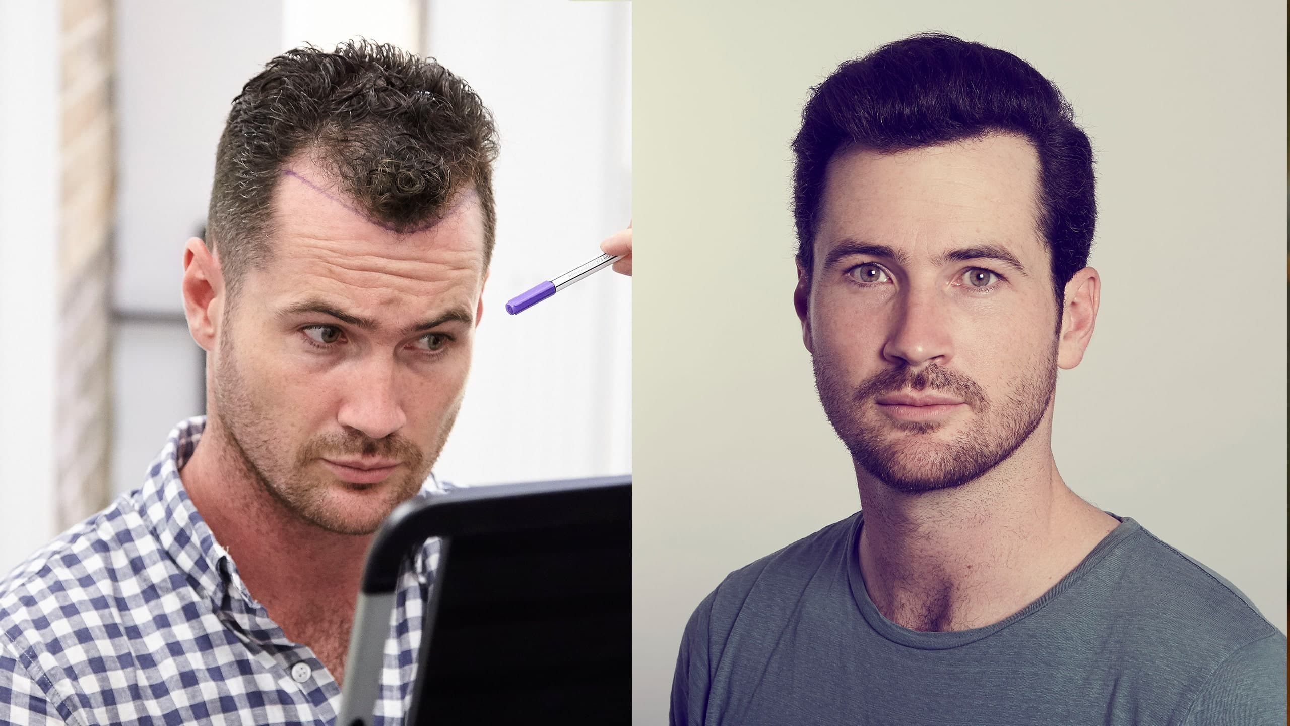 Hair Transplant UK – Transform Your Look with Westminster Medical Group®