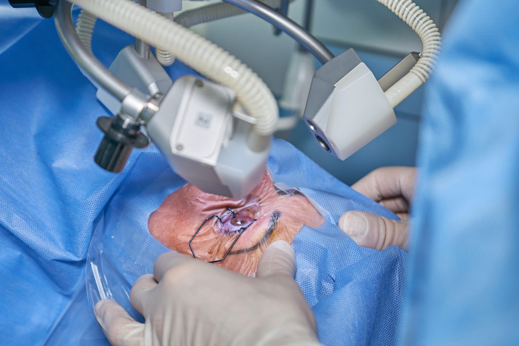 LASIK Istanbul vs. LASIK Turkey: Key Differences