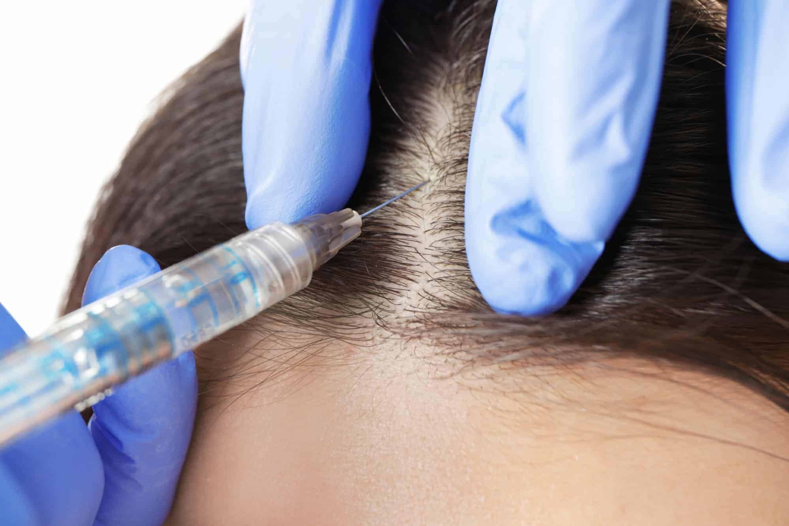 Hair Transplant Istanbul: Expert Surgeons, Stunning Results