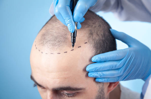 Hair Transplant Turkey Cost vs Europe: Huge Savings Revealed